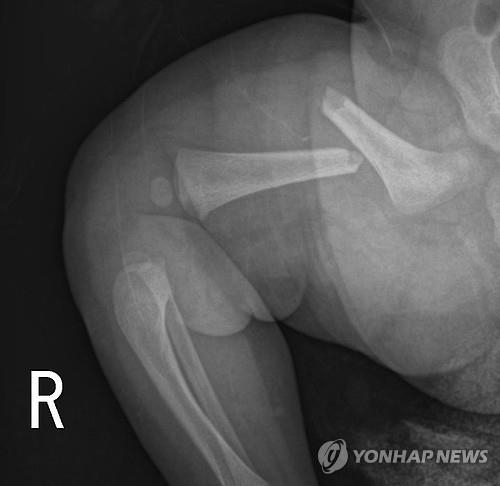 '생후 50일 딸 허벅지뼈 골절' 친모 "남편 구속 수사해야"(종합) - 2