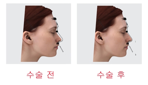 울산대 교원기업의 환자 맞춤형 코 성형수술 가이드 제품