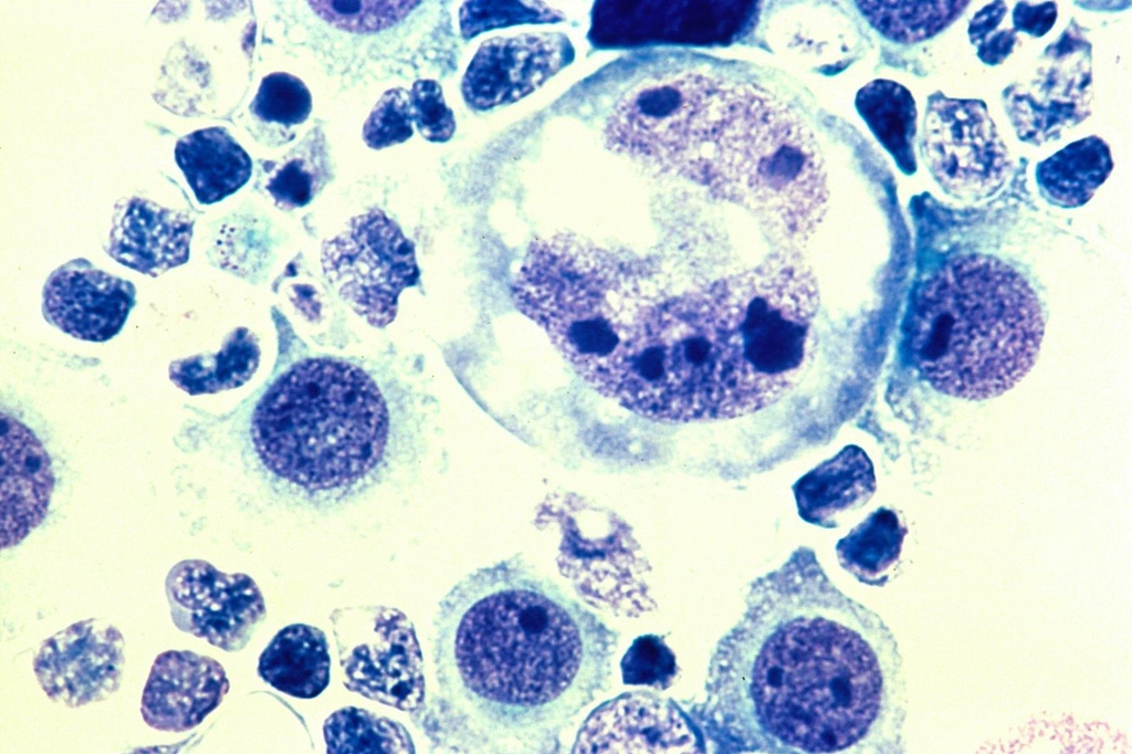 인간 림프종 세포