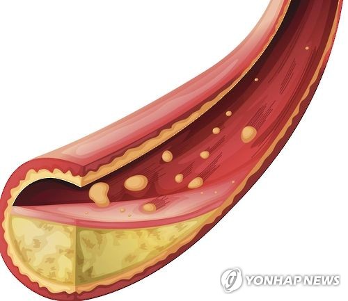 동맥경화(일러스트)