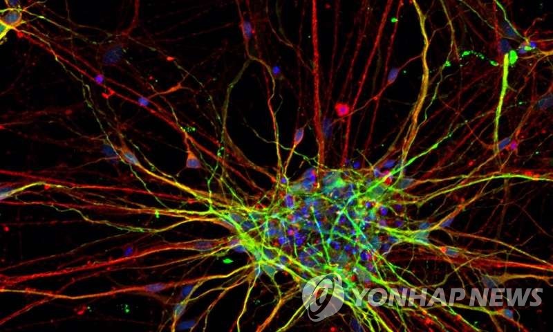 정상인보다 빠르게 자라는 자폐증 환자의 뇌 신경세포
