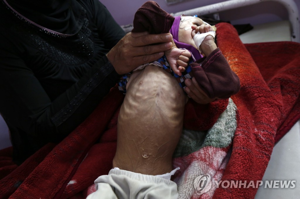 예멘에서 기아에 시달리는 어린이 