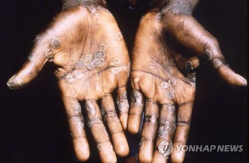 원숭이두창 감염자의 손바닥