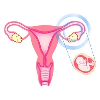 건선 증상땐 자궁 외 임신 가능성 커진다…