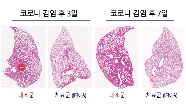 폐 조직분석 결과(염증 부위 분홍색). 인터페론 람다를 비강 흡입한 코로나 감염 동물 모델은 대조군에 비해 폐 조직의 염증이 덜했다. [서울대병원 제공]