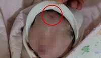 [OK!제보] 제왕절개로 낳은 딸 얼굴에 칼자국…어이없는 병원 대응에 분통
