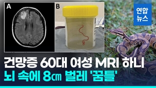  호주서 건망증 앓던 여성 뇌 속에 8㎝ 벌레 '꿈틀'