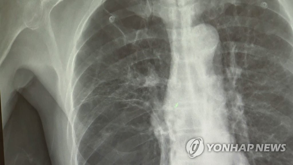 15년간 폐암 추적해보니…발생률 상승세에도 5년 생존율 2배↑